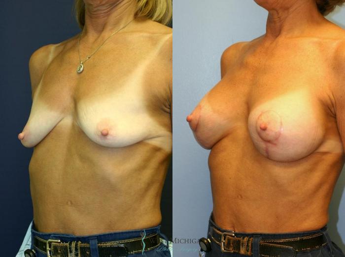Before & After Breast Augmentation with Lift Case 8910 View #3 View in Portage, Kalamazoo, Battle Creek, Michigan
