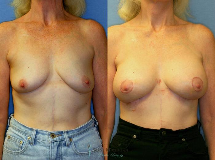 Before & After Breast Augmentation with Lift Case 8911 View #1 View in Portage, Kalamazoo, Battle Creek, Michigan
