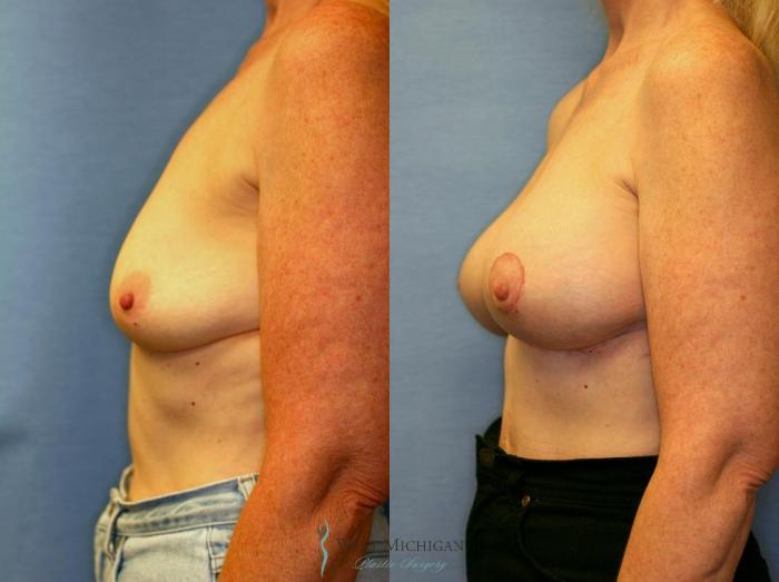Before & After Breast Augmentation with Lift Case 8911 View #2 View in Portage, Kalamazoo, Battle Creek, Michigan