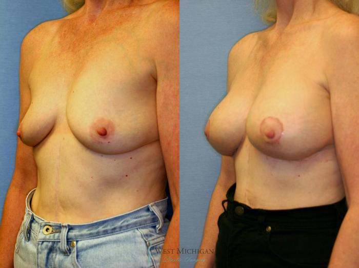 Before & After Breast Augmentation with Lift Case 8911 View #3 View in Portage, Kalamazoo, Battle Creek, Michigan