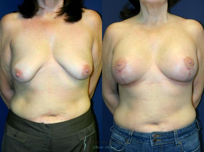 Before & After Breast Augmentation with Lift Case 8912 View #1 View in Portage, Kalamazoo, Battle Creek, Michigan