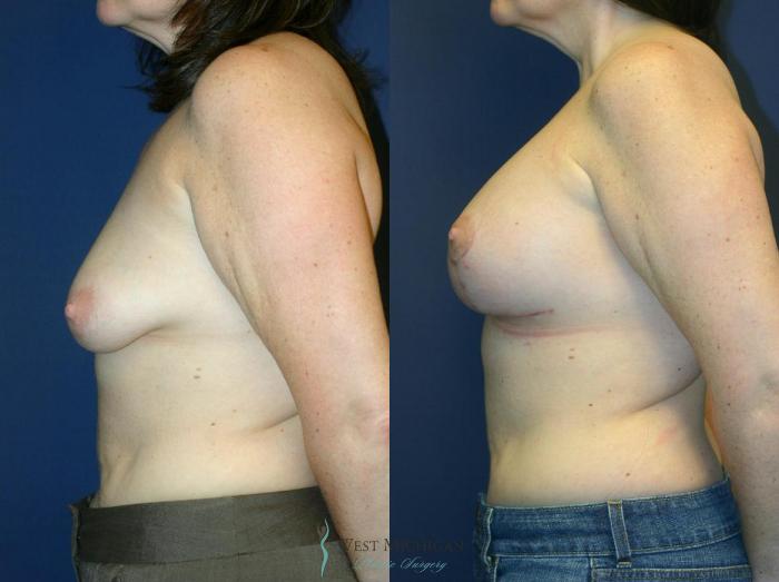 Before & After Breast Augmentation with Lift Case 8912 View #2 View in Portage, Kalamazoo, Battle Creek, Michigan