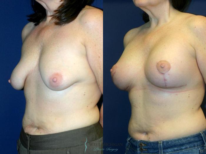 Before & After Breast Augmentation with Lift Case 8912 View #3 View in Portage, Kalamazoo, Battle Creek, Michigan