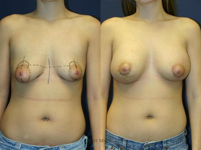 Before & After Breast Augmentation with Lift Case 8913 View #1 View in Portage, Kalamazoo, Battle Creek, Michigan