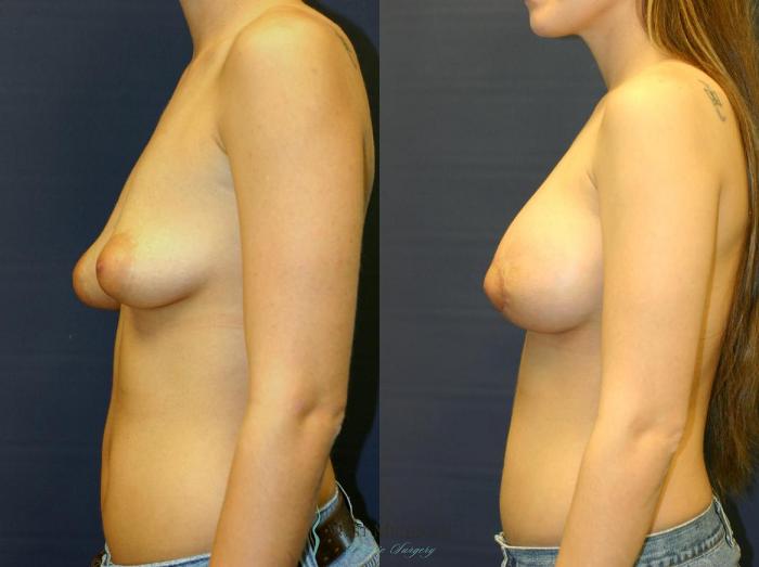 Before & After Breast Augmentation with Lift Case 8913 View #2 View in Portage, Kalamazoo, Battle Creek, Michigan