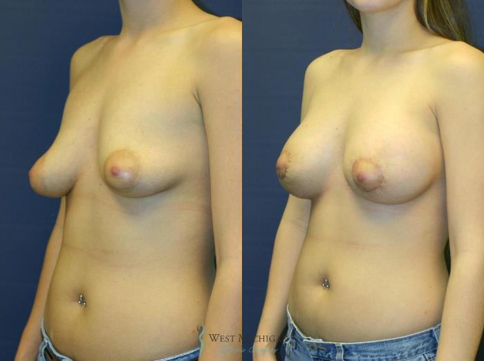 Before & After Breast Augmentation with Lift Case 8913 View #3 View in Portage, Kalamazoo, Battle Creek, Michigan