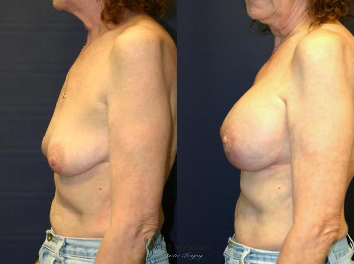 Before & After Breast Augmentation with Lift Case 8914 View #2 View in Portage, Kalamazoo, Battle Creek, Michigan