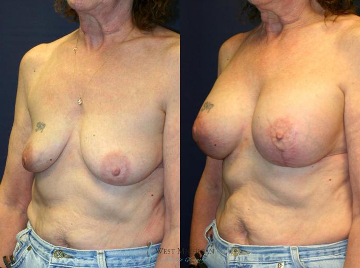 Before & After Breast Augmentation with Lift Case 8914 View #3 View in Portage, Kalamazoo, Battle Creek, Michigan