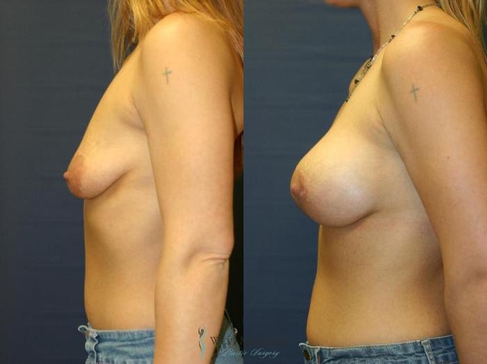 Before & After Breast Augmentation with Lift Case 8915 View #2 View in Portage, Kalamazoo, Battle Creek, Michigan