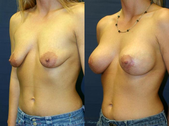 Before & After Breast Augmentation with Lift Case 8915 View #3 View in Portage, Kalamazoo, Battle Creek, Michigan