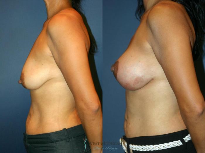 Before & After Breast Augmentation with Lift Case 8916 View #2 View in Portage, Kalamazoo, Battle Creek, Michigan