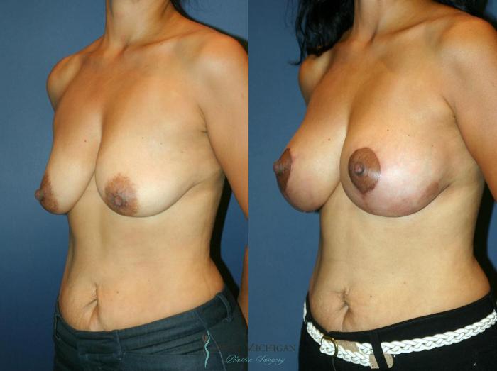 Before & After Breast Augmentation with Lift Case 8916 View #3 View in Portage, Kalamazoo, Battle Creek, Michigan