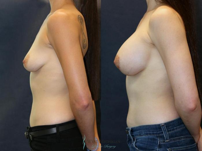 Before & After Breast Augmentation with Lift Case 8917 View #2 View in Portage, Kalamazoo, Battle Creek, Michigan