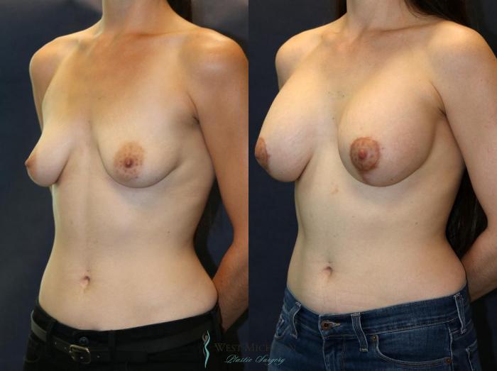 Before & After Breast Augmentation with Lift Case 8917 View #3 View in Portage, Kalamazoo, Battle Creek, Michigan