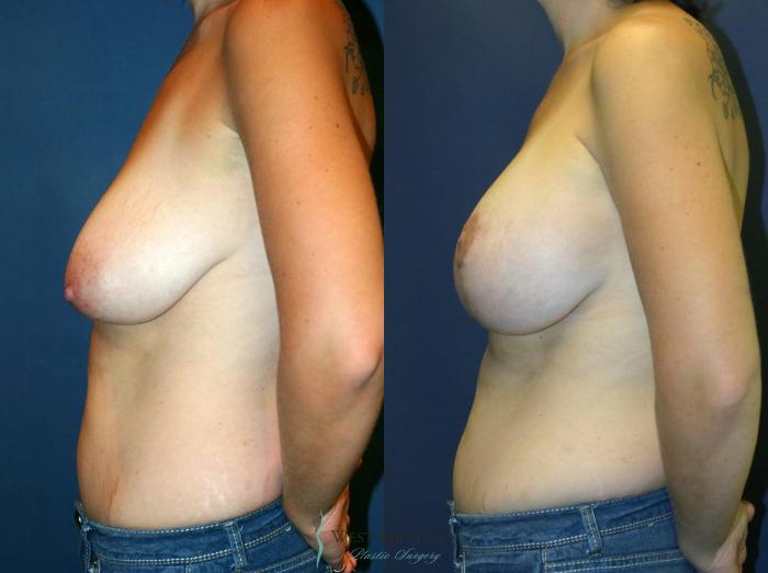 Before & After Breast Augmentation with Lift Case 8918 View #2 View in Portage, Kalamazoo, Battle Creek, Michigan