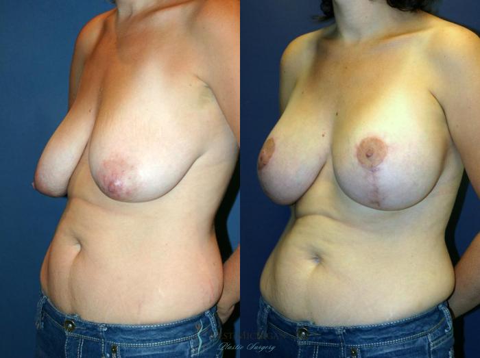Before & After Breast Augmentation with Lift Case 8918 View #3 View in Portage, Kalamazoo, Battle Creek, Michigan