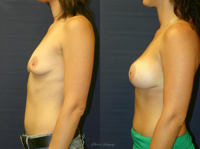 Before & After Breast Augmentation with Lift Case 8920 View #2 View in Portage, Kalamazoo, Battle Creek, Michigan