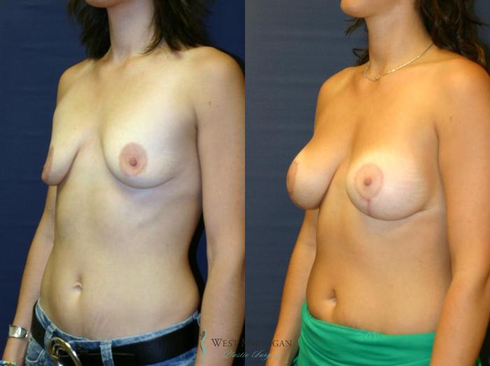 Before & After Breast Augmentation with Lift Case 8920 View #3 View in Portage, Kalamazoo, Battle Creek, Michigan