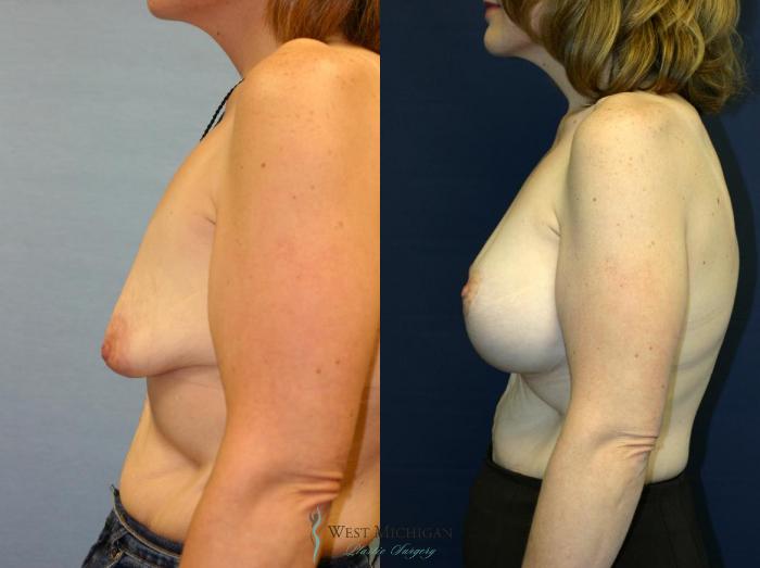 Before & After Breast Augmentation with Lift Case 8921 View #2 View in Portage, Kalamazoo, Battle Creek, Michigan