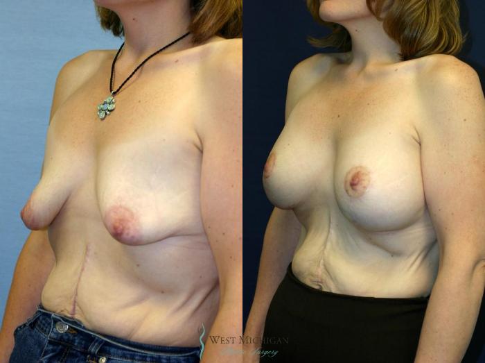Before & After Breast Augmentation with Lift Case 8921 View #3 View in Portage, Kalamazoo, Battle Creek, Michigan