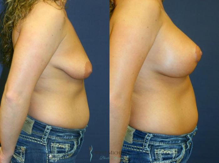 Before & After Breast Augmentation with Lift Case 8922 View #2 View in Portage, Kalamazoo, Battle Creek, Michigan