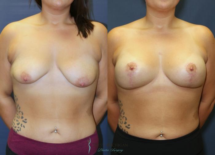 Before & After Breast Augmentation with Lift Case 9391 Front View in Portage, Kalamazoo, Battle Creek, Michigan