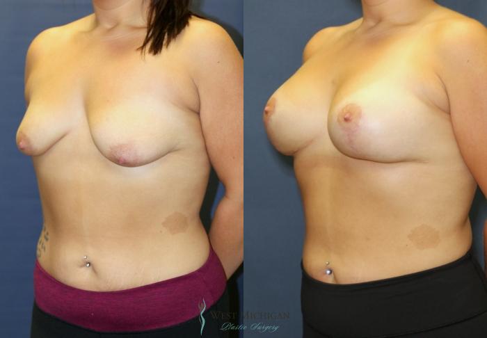Before & After Breast Augmentation with Lift Case 9391 Left Oblique View in Portage, Kalamazoo, Battle Creek, Michigan
