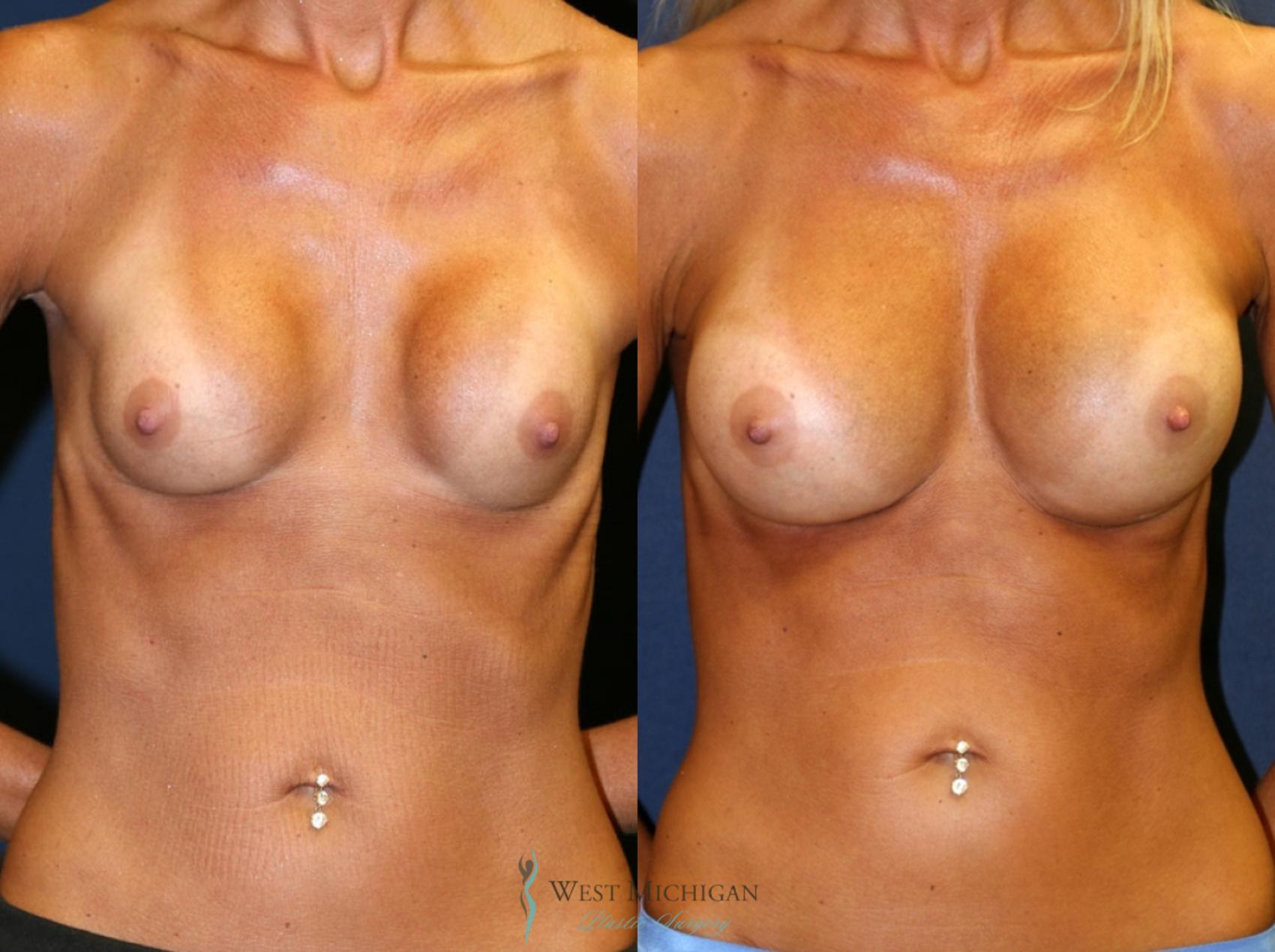 Before & After Breast Implant Revision Case 8724 View #1 View in Portage, Kalamazoo, Battle Creek, Michigan