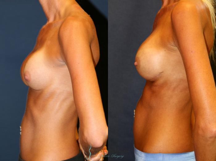 Before & After Breast Implant Revision Case 8724 View #2 View in Portage, Kalamazoo, Battle Creek, Michigan