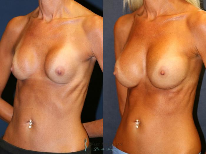 Before & After Breast Implant Revision Case 8724 View #3 View in Portage, Kalamazoo, Battle Creek, Michigan