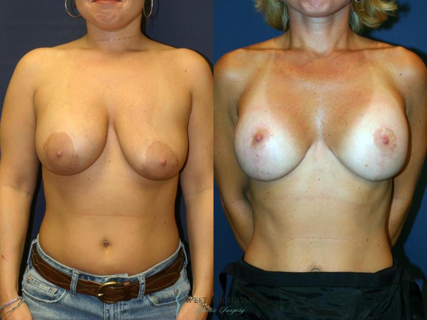 Before & After Breast Implant Revision Case 8923 View #1 View in Portage, Kalamazoo, Battle Creek, Michigan