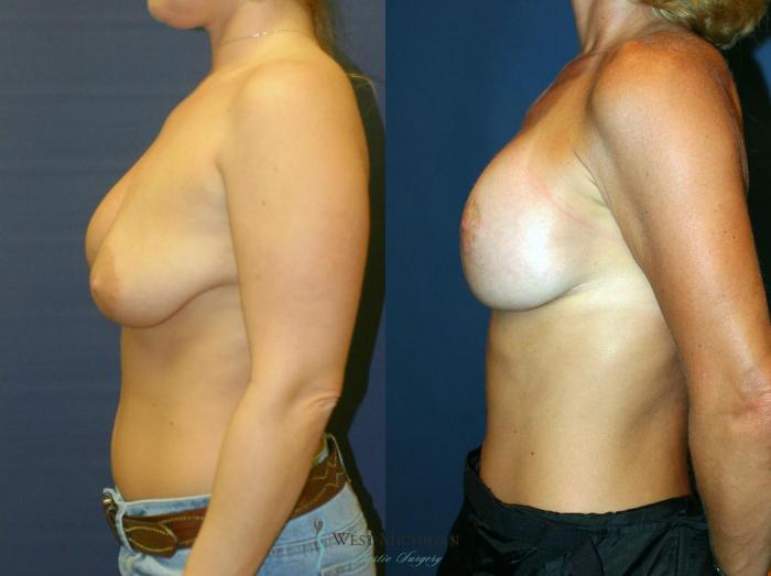 Before & After Breast Implant Revision Case 8923 View #2 View in Portage, Kalamazoo, Battle Creek, Michigan