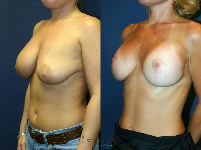 Before & After Breast Implant Revision Case 8923 View #3 View in Portage, Kalamazoo, Battle Creek, Michigan