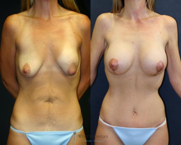 Before & After Breast Implant Revision Case 8924 View #1 View in Portage, Kalamazoo, Battle Creek, Michigan