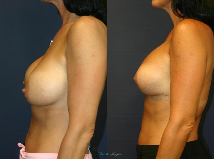 Before & After Breast Implant Revision Case 8925 View #2 View in Portage, Kalamazoo, Battle Creek, Michigan