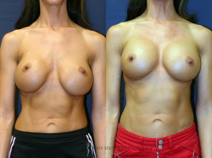 Before & After Breast Implant Revision Case 8926 View #1 View in Portage, Kalamazoo, Battle Creek, Michigan