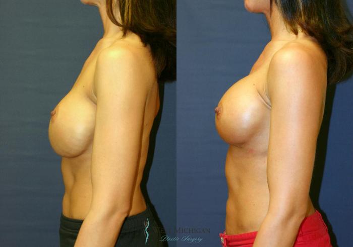 Before & After Breast Implant Revision Case 8926 View #2 View in Portage, Kalamazoo, Battle Creek, Michigan