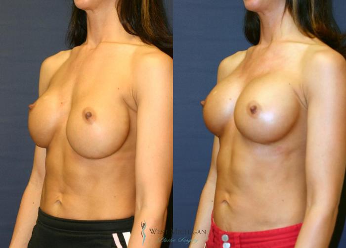 Before & After Breast Implant Revision Case 8926 View #3 View in Portage, Kalamazoo, Battle Creek, Michigan