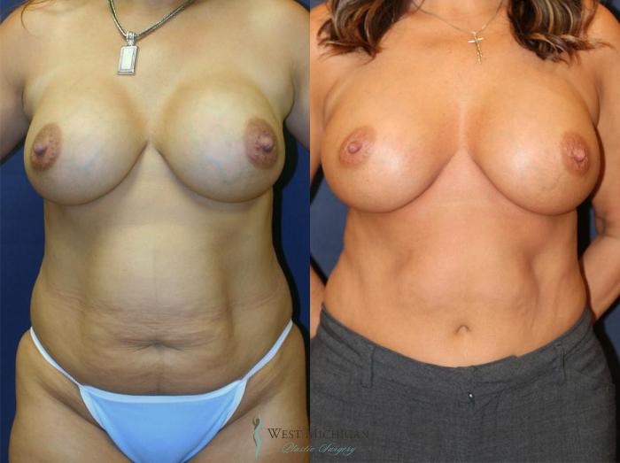 Before & After Breast Implant Revision Case 8927 View #1 View in Portage, Kalamazoo, Battle Creek, Michigan