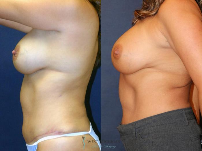 Before & After Breast Implant Revision Case 8927 View #3 View in Portage, Kalamazoo, Battle Creek, Michigan