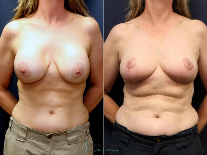Before & After Breast Implant Revision Case 8928 View #1 View in Portage, Kalamazoo, Battle Creek, Michigan