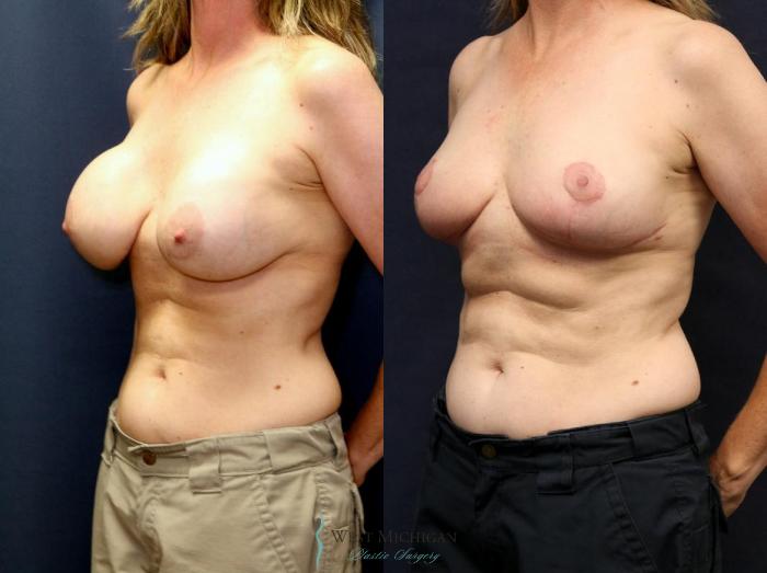 Before & After Breast Implant Revision Case 8928 View #2 View in Portage, Kalamazoo, Battle Creek, Michigan