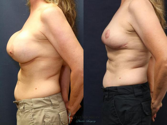 Before & After Breast Implant Revision Case 8928 View #3 View in Portage, Kalamazoo, Battle Creek, Michigan