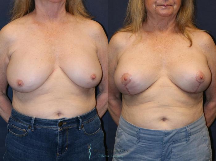 Before & After Breast Implant Revision Case 8929 View #1 View in Portage, Kalamazoo, Battle Creek, Michigan