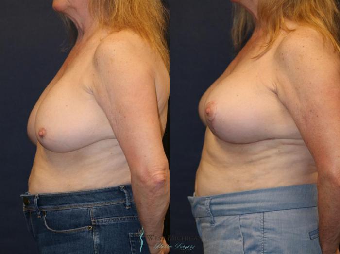Before & After Breast Implant Revision Case 8929 View #2 View in Portage, Kalamazoo, Battle Creek, Michigan