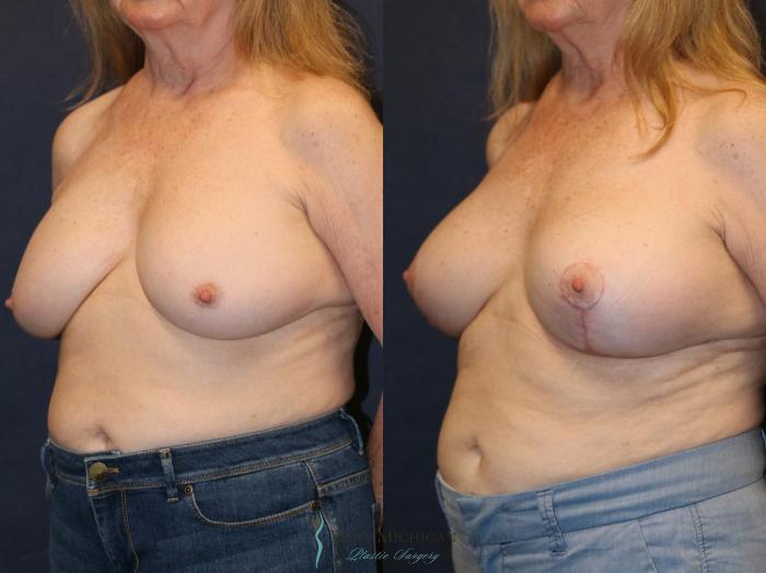 Before & After Breast Implant Revision Case 8929 View #3 View in Portage, Kalamazoo, Battle Creek, Michigan