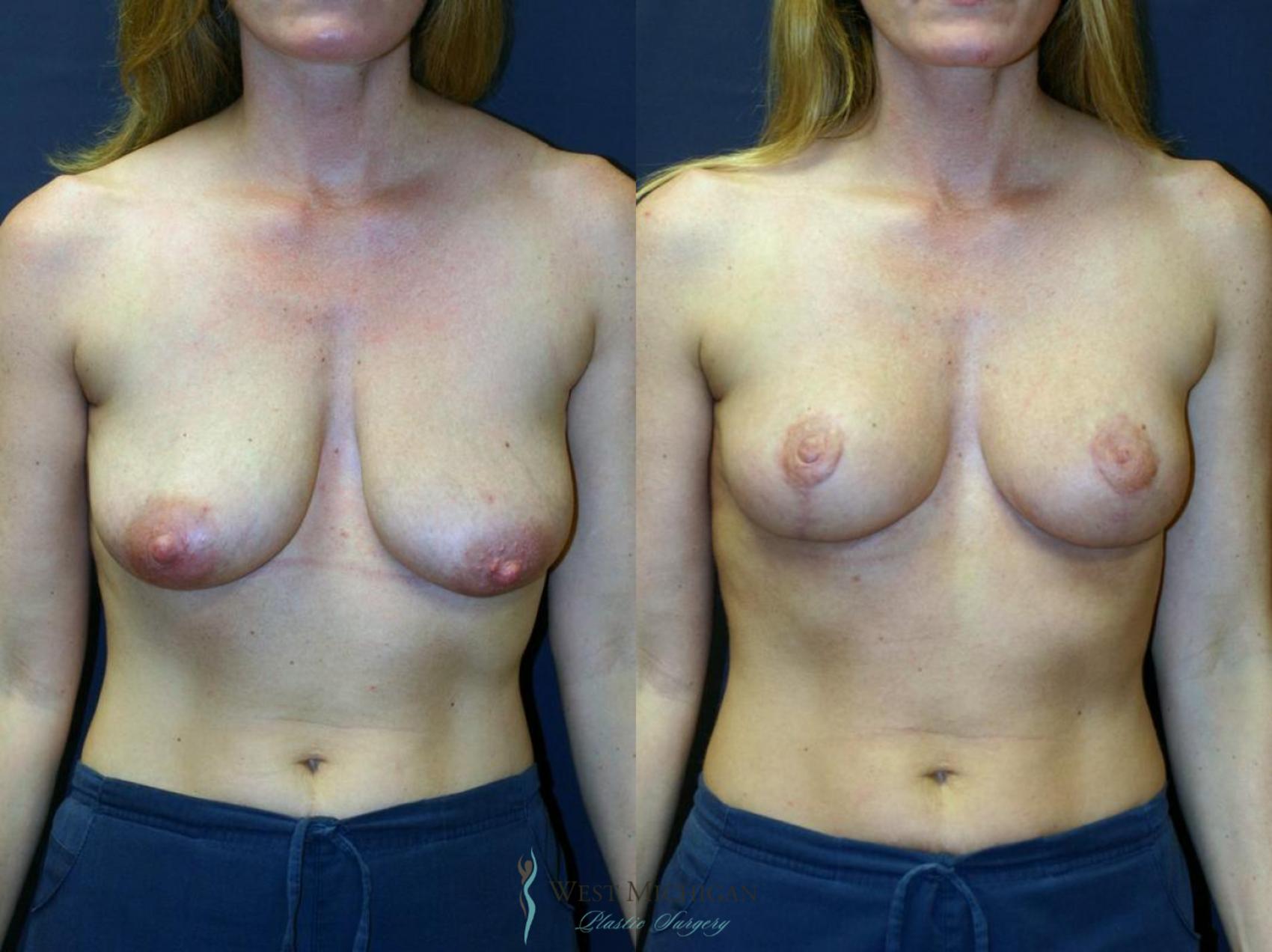 Before & After Breast Lift Case 8696 View #1 View in Portage, Kalamazoo, Battle Creek, Michigan