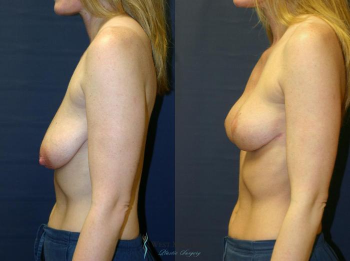 Before & After Breast Lift Case 8696 View #2 View in Portage, Kalamazoo, Battle Creek, Michigan