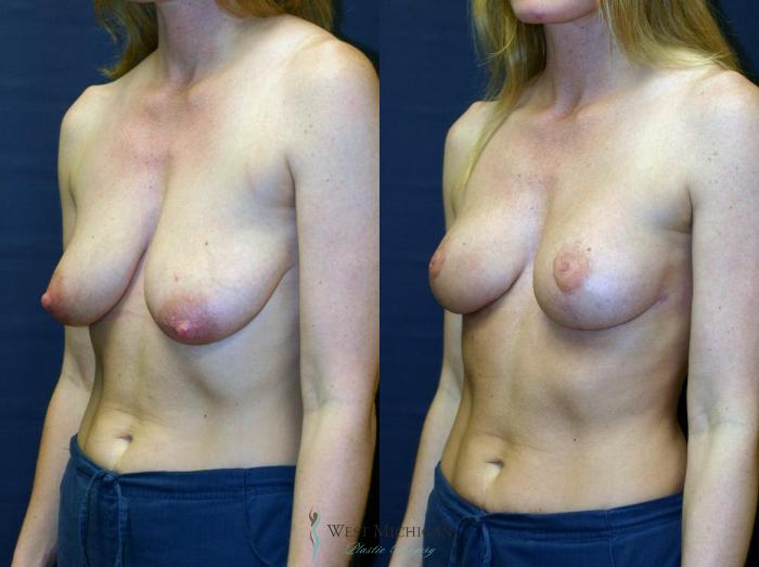 Before & After Breast Lift Case 8696 View #3 View in Portage, Kalamazoo, Battle Creek, Michigan