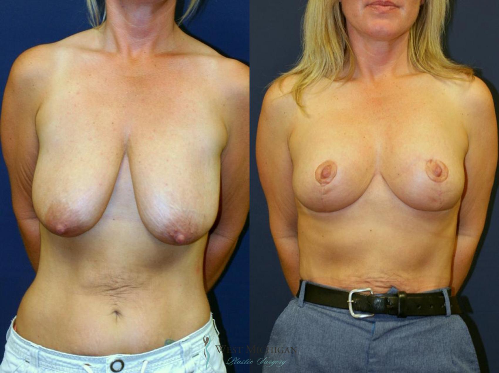 Before & After Breast Lift Case 8946 View #1 View in Portage, Kalamazoo, Battle Creek, Michigan